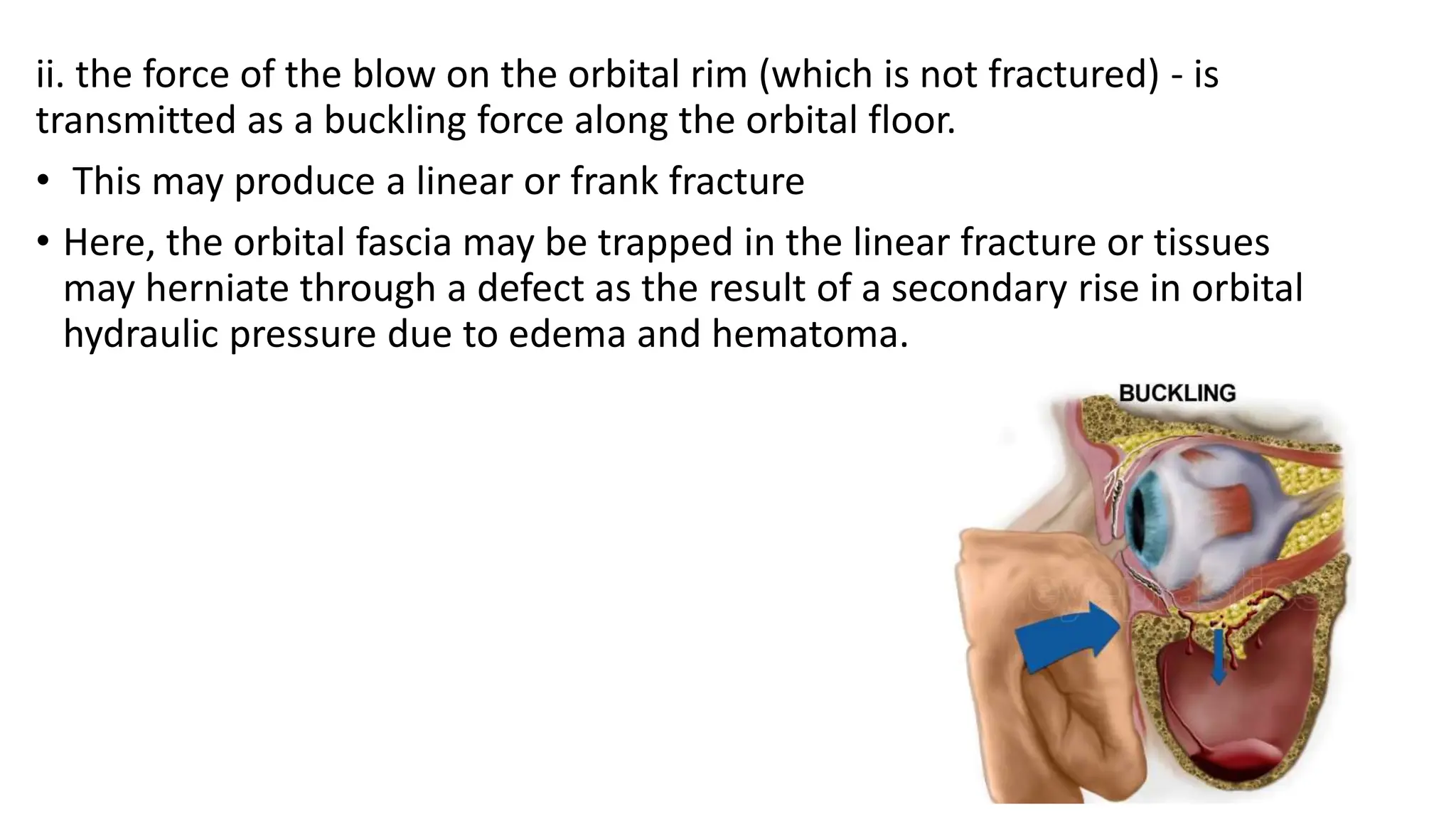 ORBITAL FRACTURES.pptx