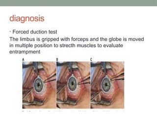 ORBITAL FRACTURES.pptx and the appropriate management | PPTX