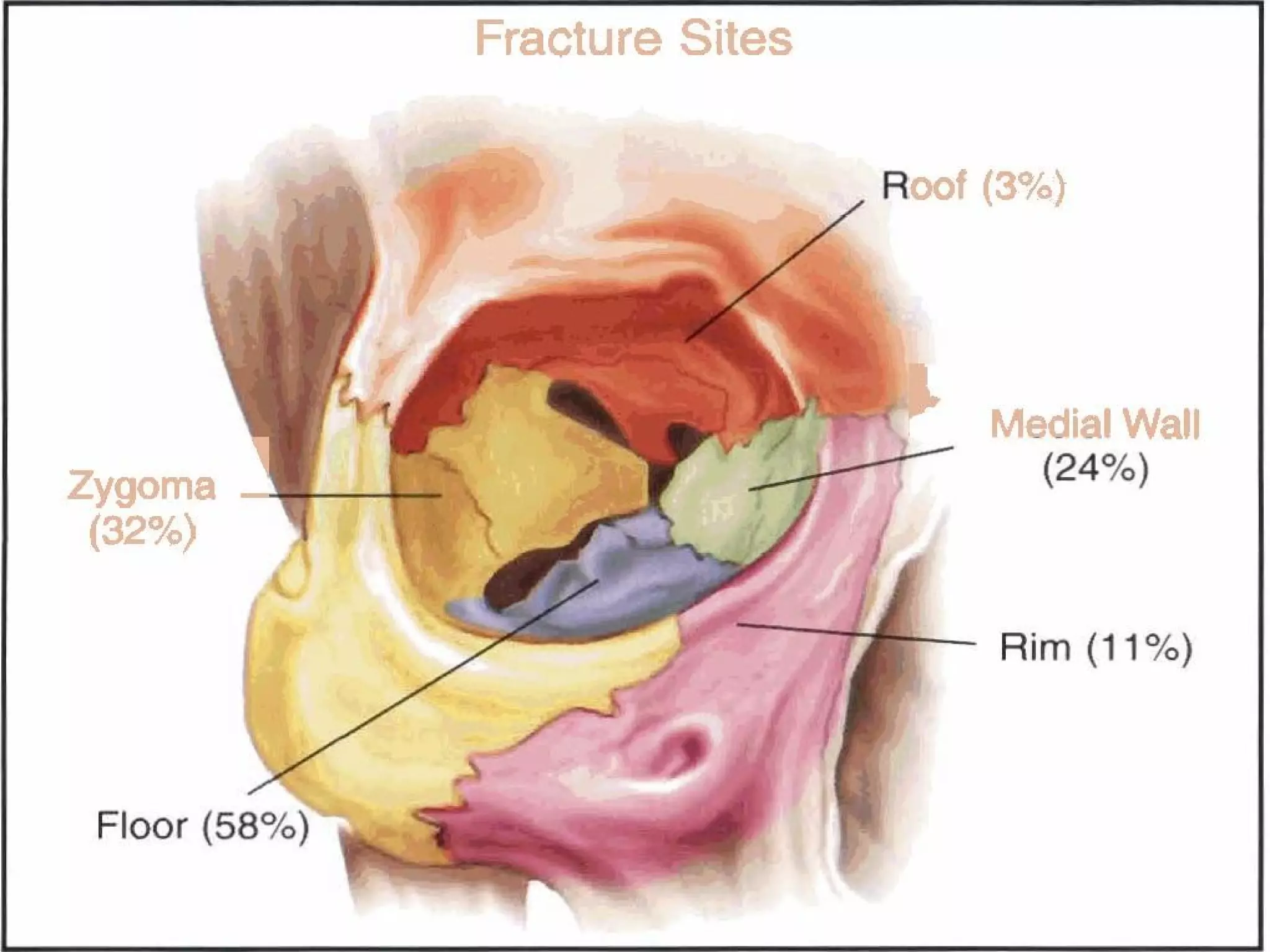 Orbital fractures ih | PPT