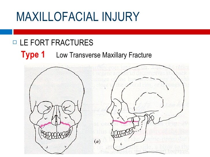 Orbital Fractures - The Role of an Ophthalmologist