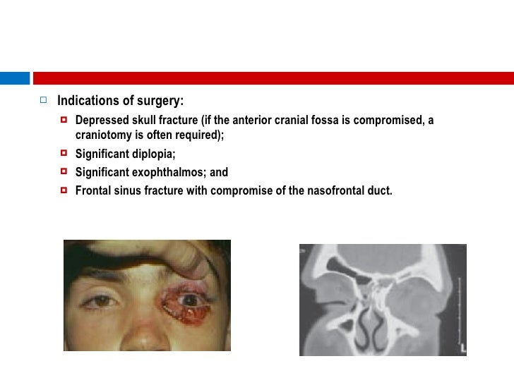 Orbital Fractures The Role Of An Ophthalmologist