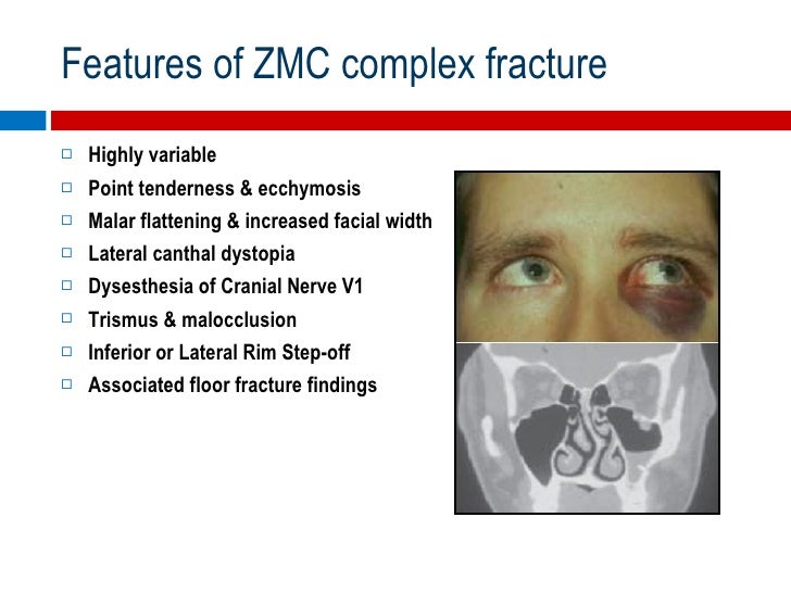 Orbital Fractures The Role of an Ophthalmologist