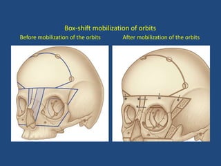 Box-shift mobilization of orbits
Before mobilization of the orbits After mobilization of the orbits
 