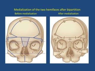 Medialization of the two hemifaces after bipartition
Before medialization After medialization
 