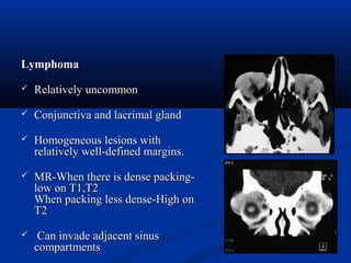 LymphomaLymphoma
 Relatively uncommonRelatively uncommon
 Conjunctiva and lacrimal glandConjunctiva and lacrimal gland
 Homogeneous lesions withHomogeneous lesions with
relatively well-defined margins.relatively well-defined margins.
 MR-When there is dense packing-MR-When there is dense packing-
low on T1,T2low on T1,T2
When packing less dense-High onWhen packing less dense-High on
T2T2
 Can invade adjacent sinusCan invade adjacent sinus
compartmentscompartments
 