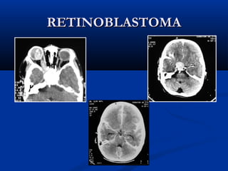 RETINOBLASTOMARETINOBLASTOMA
 