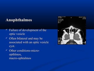 AnophthalmosAnophthalmos
 Failure of development of theFailure of development of the
optic vesicleoptic vesicle
 Often bilateral and may beOften bilateral and may be
associated with an optic vesicleassociated with an optic vesicle
cyst.cyst.
 Other conditions-micro-Other conditions-micro-
opthlmos,opthlmos,
macro-ophtalmosmacro-ophtalmos
 