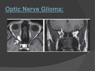Optic Nerve Glioma:
 