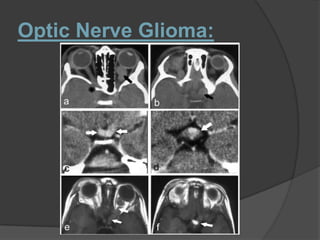Optic Nerve Glioma:
 