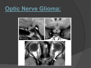 Optic Nerve Glioma:
 