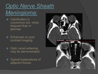 Optic Nerve Sheath
Meningioma:
 Calcification is
uncommon but more
frequent than in
gliomas.
 Enhanced on post
contrast imaging.
 Optic canal widening
may be demonstrated.
 Typical hyperostosis of
adjacent bones.
 