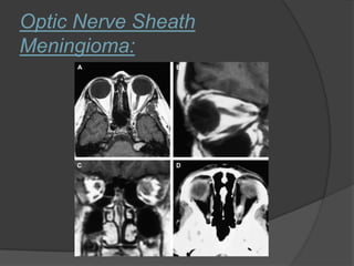 Optic Nerve Sheath
Meningioma:
 