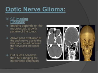 Optic Nerve Glioma:
 CT Imaging
Findings:
 Imaging depends on the
macroscopic growth
pattern of the tumor.
 Allows good evaluation of
the optic nerve due to the
intrinsic contrast between
the nerve and the conal
fat.
 But is less sensitive
than MR imaging for
intracranial extension.
 