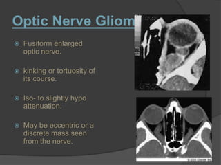 Optic Nerve Glioma:
 Fusiform enlarged
optic nerve.
 kinking or tortuosity of
its course.
 Iso- to slightly hypo
attenuation.
 May be eccentric or a
discrete mass seen
from the nerve.
 
