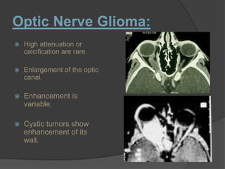 Optic Nerve Glioma:
 High attenuation or
calcification are rare.
 Enlargement of the optic
canal.
 Enhancement is
variable.
 Cystic tumors show
enhancement of its
wall.
 