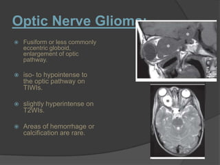 Optic Nerve Glioma:
 Fusiform or less commonly
eccentric globoid,
enlargement of optic
pathway.
 iso- to hypointense to
the optic pathway on
TIWIs.
 slightly hyperintense on
T2WIs.
 Areas of hemorrhage or
calcification are rare.
 