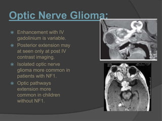 Optic Nerve Glioma:
 Enhancement with IV
gadolinium is variable.
 Posterior extension may
at seen only at post IV
contrast imaging.
 Isolated optic nerve
glioma more common in
patients with NF1.
 Optic pathways
extension more
common in children
without NF1.
 