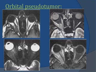 Orbital pseudotumor:
 
