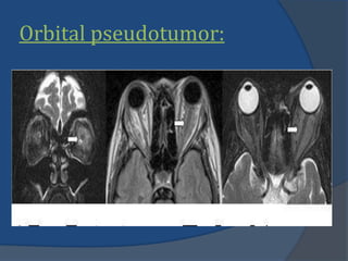 Orbital pseudotumor:
 