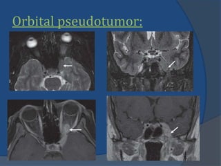 Orbital pseudotumor:
 