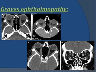 Graves ophthalmopathy:
 