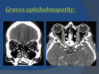 Graves ophthalmopathy:
 