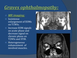 Graves ophthalmopathy:
 MR imaging:
 Isointense
enlargement of EOMs
on T1WIs.
 Increase EOM signals
on acute phase and
decrease signal on
chronic phase on
T2WIs and STIR.
 Heterogeneous
enhancement of
involved muscles.
 