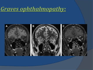 Graves ophthalmopathy:
 