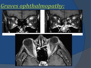 Graves ophthalmopathy:
 