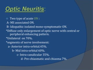 Optic Neuritis:
 Two type of acute ON :
A- MS associated ON.
B- Idiopathic isolated mono-symptomativ ON.
*Diffuse only enlargement of optic nerve with central or
peripheral enhancing pattern.
*Unilateral on 70%.
*segments of nerve involvement:
a- Anterior intra-orbital.45%.
b- Mid intra-orbital 60%.
c- Intra-canalicular 35%.
d- Pre-chiasmatic and chiasma 7%.
 