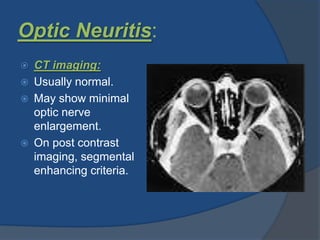 Optic Neuritis:
 CT imaging:
 Usually normal.
 May show minimal
optic nerve
enlargement.
 On post contrast
imaging, segmental
enhancing criteria.
 