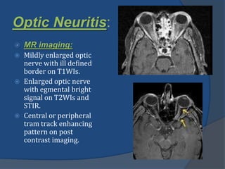 Optic Neuritis:
 MR imaging:
 Mildly enlarged optic
nerve with ill defined
border on T1WIs.
 Enlarged optic nerve
with egmental bright
signal on T2WIs and
STIR.
 Central or peripheral
tram track enhancing
pattern on post
contrast imaging.
 