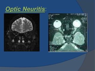 Optic Neuritis:
 