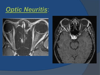Optic Neuritis:
 