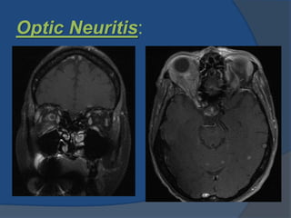 Optic Neuritis:
 