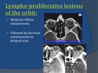 Lympho-proliferative lesions
of the orbit:
 Moderate diffuse
enhancement.
 Followed by decrease
enhancement on
delayed scan.
 