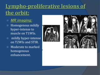 Lympho-proliferative lesions of
the orbit:
 MR imaging:
 Homogenous mildly
hyper-intense to
muscle on T1WIs.
 mildly hyper-intense
on T2WIs and STIR.
 Moderate to marked
homogenous
enhancement.
 