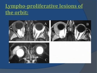 Lympho-proliferative lesions of
the orbit:
 