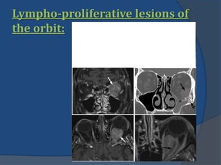 Lympho-proliferative lesions of
the orbit:
 