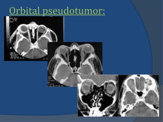 Orbital pseudotumor:
 