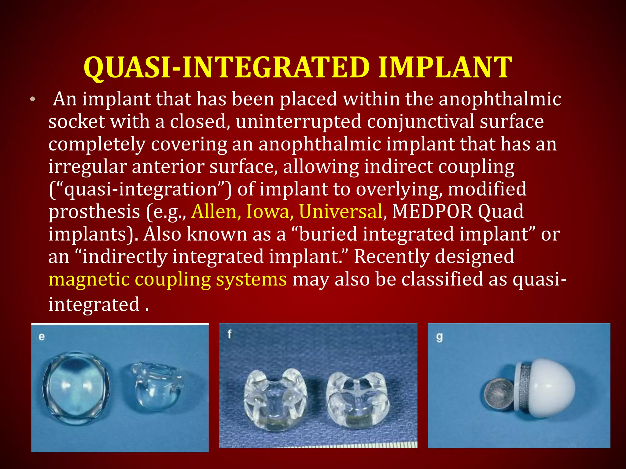 QUASI-INTEGRATED IMPLANT
• An implant that has been placed within the anophthalmic
socket with a closed, uninterrupted conjunctival surface
completely covering an anophthalmic implant that has an
irregular anterior surface, allowing indirect coupling
(“quasi-integration”) of implant to overlying, modified
prosthesis (e.g., Allen, Iowa, Universal, MEDPOR Quad
implants). Also known as a “buried integrated implant” or
an “indirectly integrated implant.” Recently designed
magnetic coupling systems may also be classified as quasi-
integrated .
 