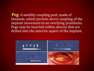 Peg: A motility coupling post, made of
titanium, which permits direct coupling of the
implant movement to an overlying prosthesis.
Pegs may be inserted within sleeves that are
drilled into the anterior aspect of the implant.
 