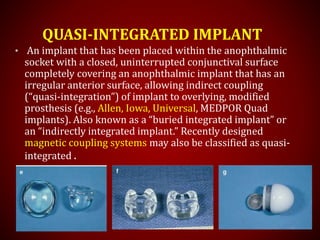 QUASI-INTEGRATED IMPLANT
• An implant that has been placed within the anophthalmic
socket with a closed, uninterrupted conjunctival surface
completely covering an anophthalmic implant that has an
irregular anterior surface, allowing indirect coupling
(“quasi-integration”) of implant to overlying, modified
prosthesis (e.g., Allen, Iowa, Universal, MEDPOR Quad
implants). Also known as a “buried integrated implant” or
an “indirectly integrated implant.” Recently designed
magnetic coupling systems may also be classified as quasi-
integrated .
 