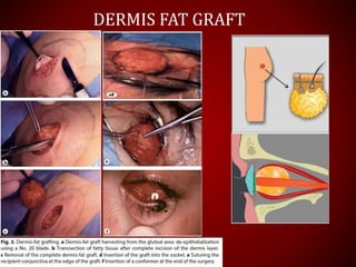 DERMIS FAT GRAFT
 