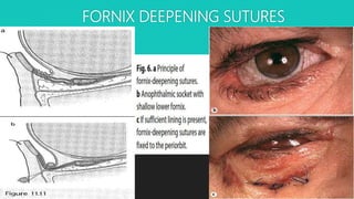 FORNIX DEEPENING SUTURES
 