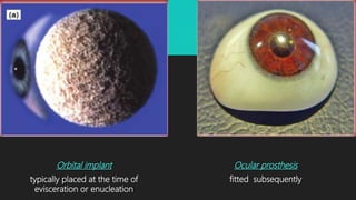 Orbital implant
typically placed at the time of
evisceration or enucleation
Ocular prosthesis
fitted subsequently
 