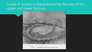 Grade-II: Socket is characterized by the loss of the
upper and lower fornices
 