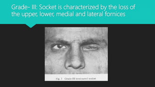 Grade- III: Socket is characterized by the loss of
the upper, lower, medial and lateral fornices
 