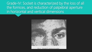 Grade-IV: Socket is characterized by the loss of all
the fornices, and reduction of palpebral aperture
in horizontal and vertical dimensions
 