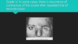 Grade-V: In some cases, there is recurrence of
contracture of the socket after repeated trial of
reconstruction
 